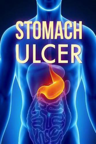 Stomach Ulcer : Treatment in 60 Days! – Stomach Ulcer Treatment, Paperback by…