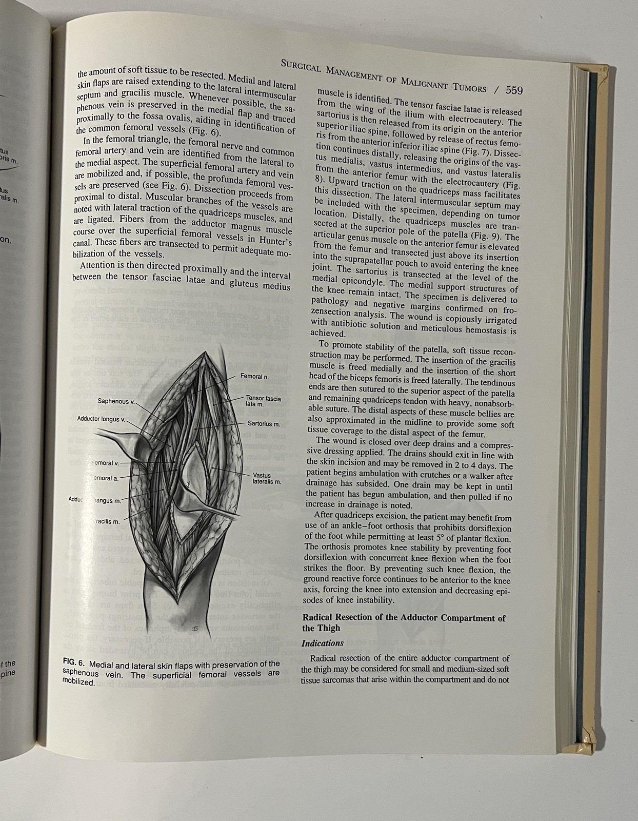 Surgery for Bone and Soft-Tissue Tumors – Simon & Springfield 1998 Hardcover
