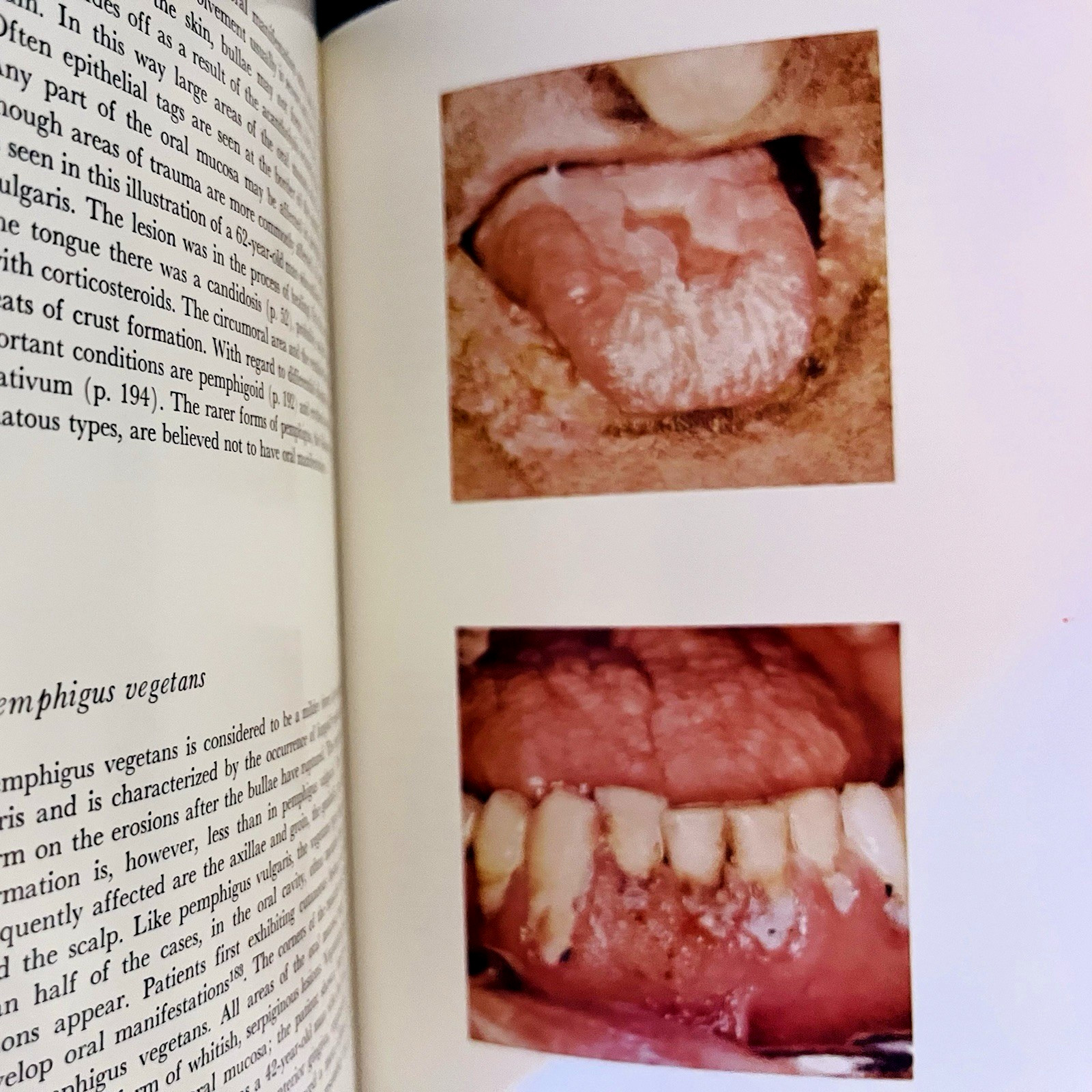 Atlas of Diseases of the Oral Mucosa Book Hardcover J. J. Pindborg 1973