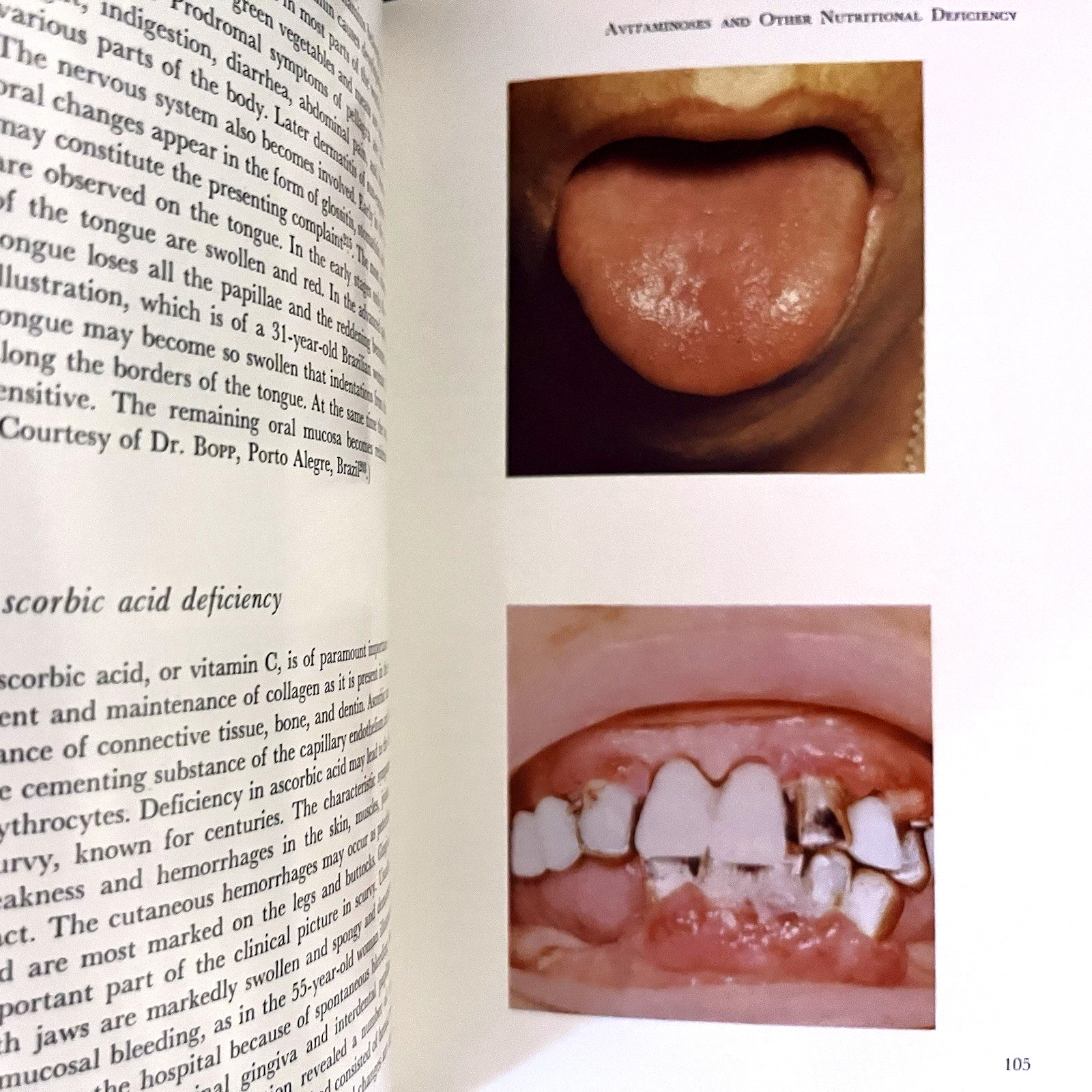 Atlas of Diseases of the Oral Mucosa Book Hardcover J. J. Pindborg 1973