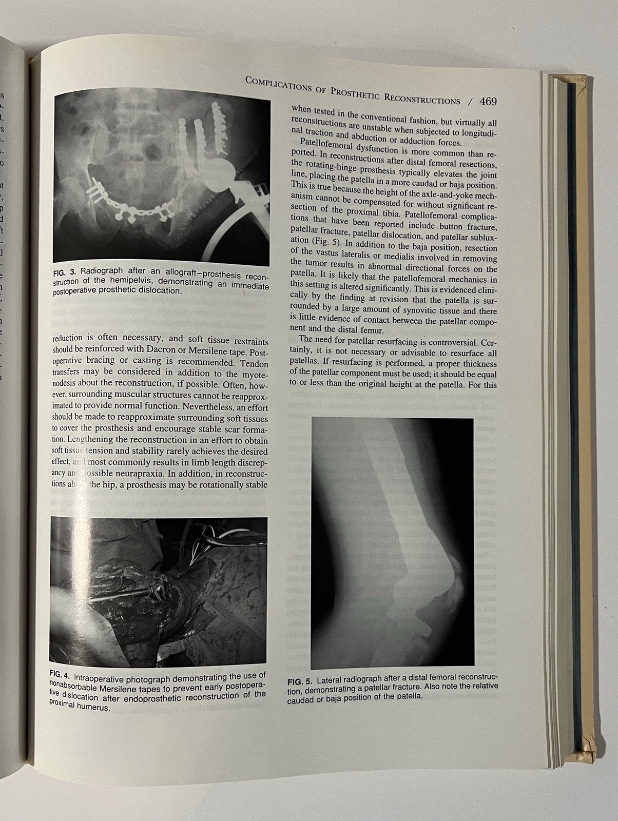 Surgery for Bone and Soft-Tissue Tumors – Simon & Springfield 1998 Hardcover