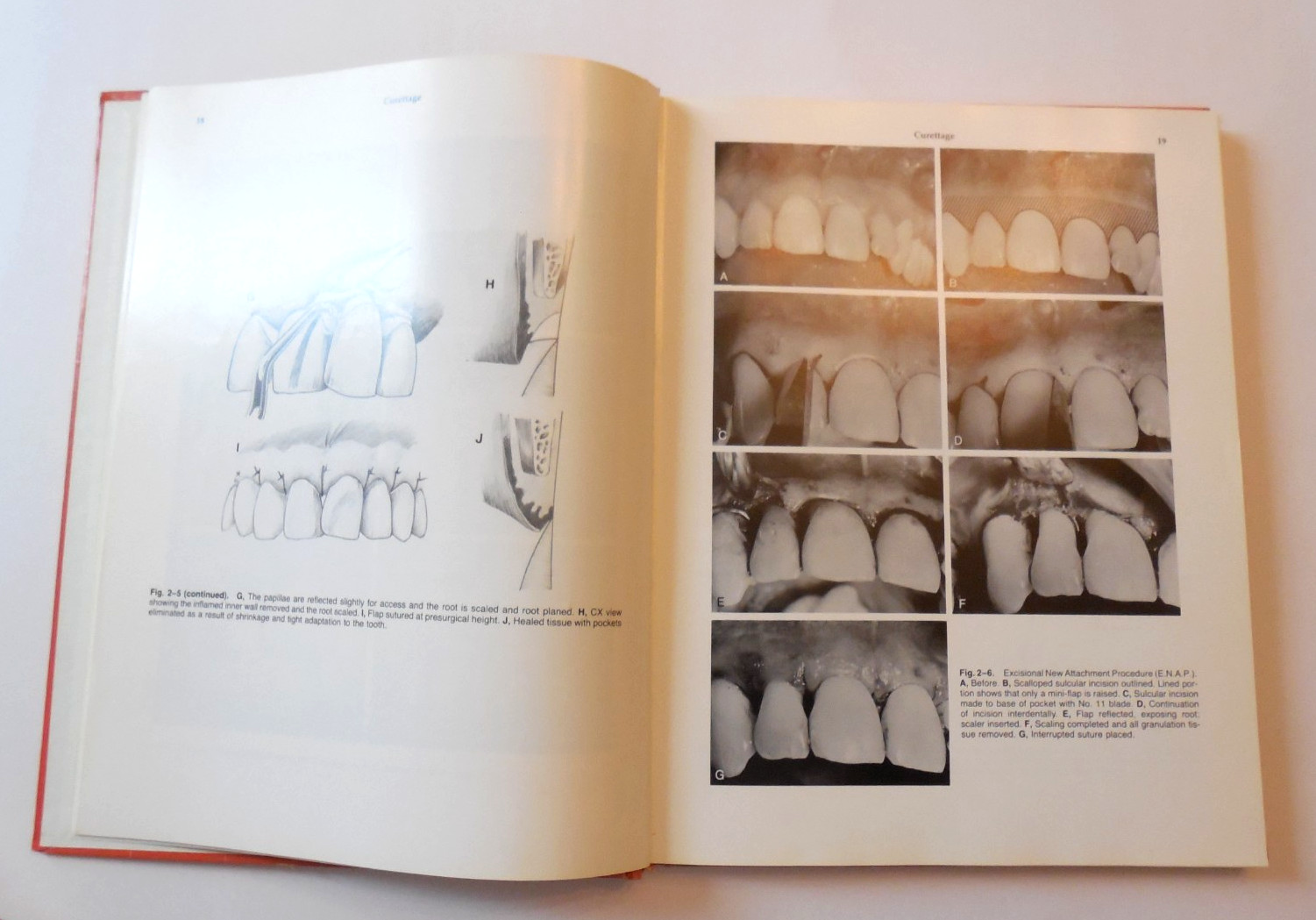 Atlas of Periodontal Surgery by Edward S. Cohen 1988 Hardcover Dentistry