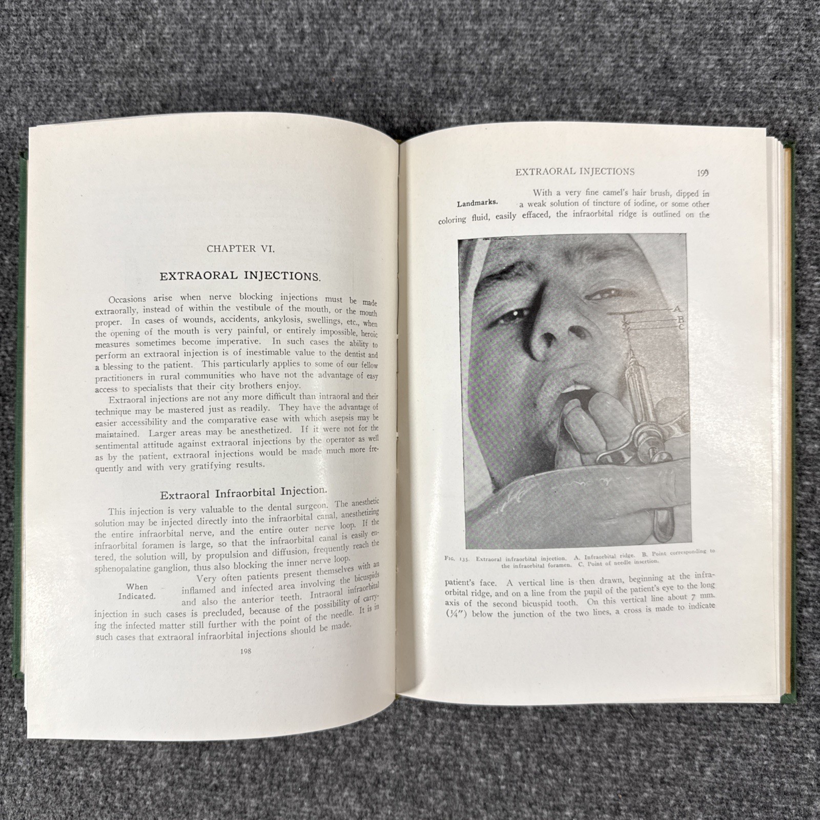 Conduction Infiltration General Anesthesia Dentistry 1943 4th Nevin & Puterbaugh