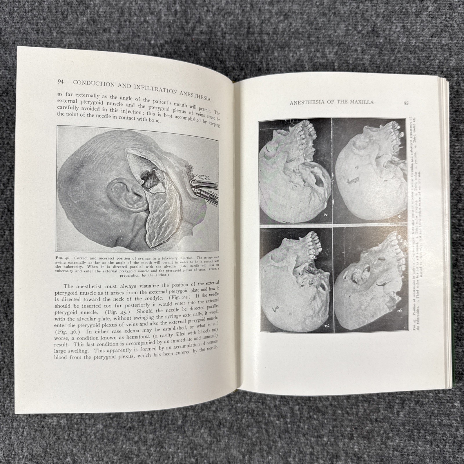 Conduction Infiltration General Anesthesia Dentistry 1943 4th Nevin & Puterbaugh